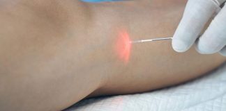 Lazer Varis Ameliyatı Sonrası